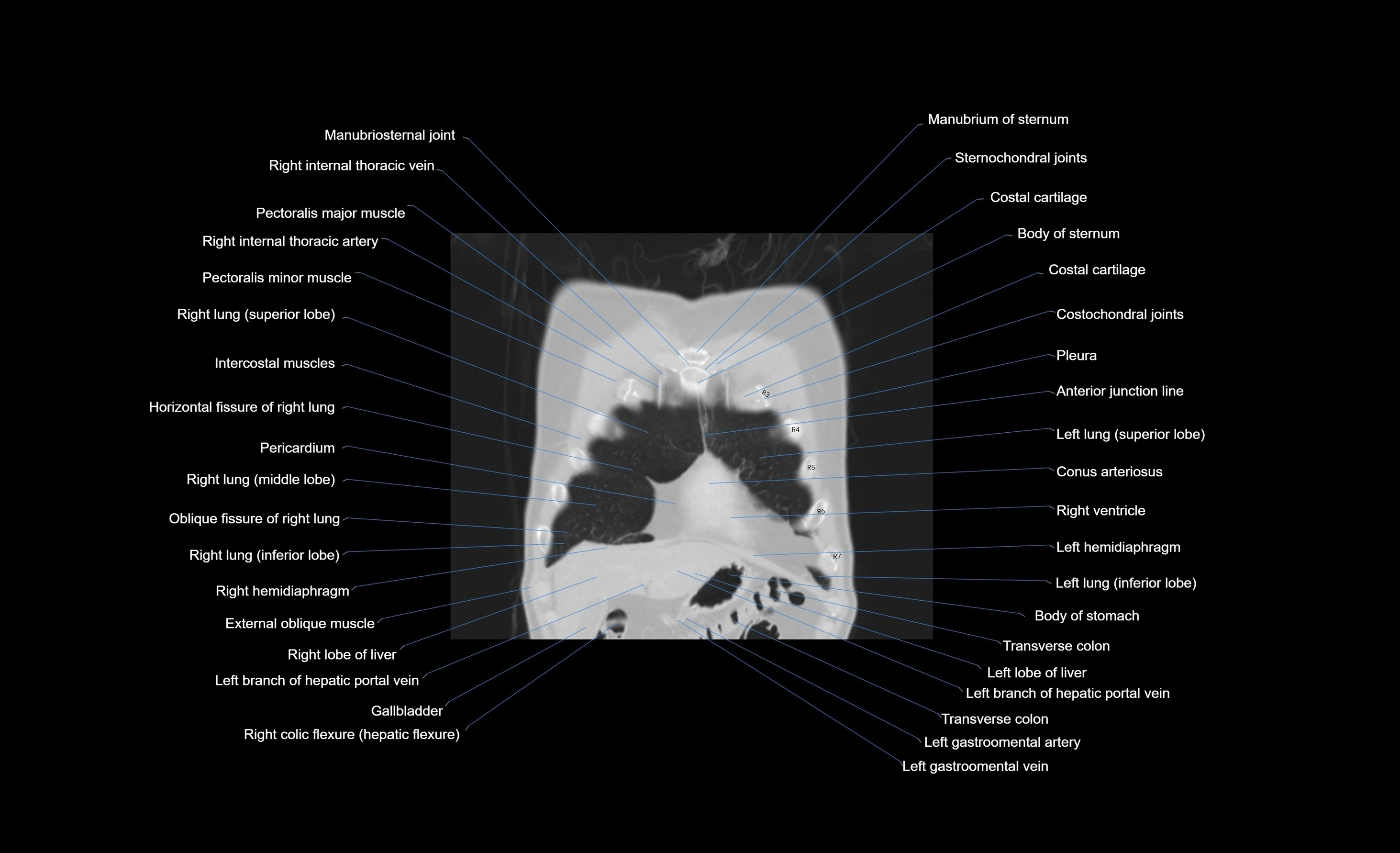 CT chest (thorax) lung window window labelled coronal cross sectional anatomy radiology image-00096.webp